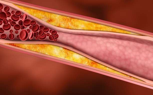 Λάθος η μέτρηση χοληστερόλης – Αλλαγή στην εξέταση